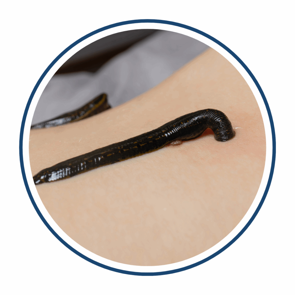 Leech Therapy
