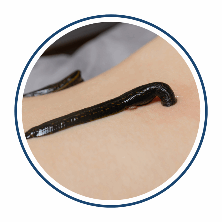 Leech Therapy