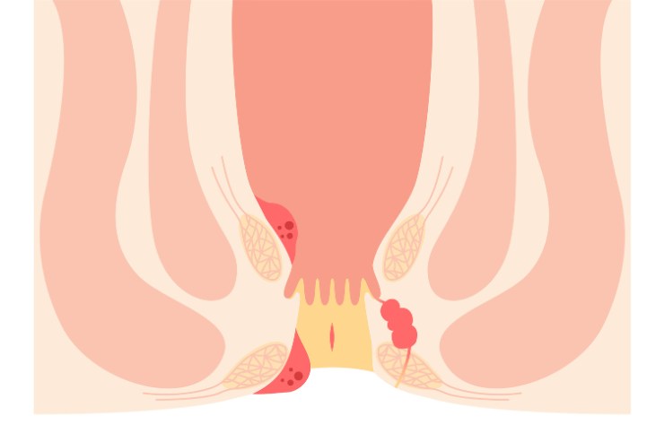 Fissure