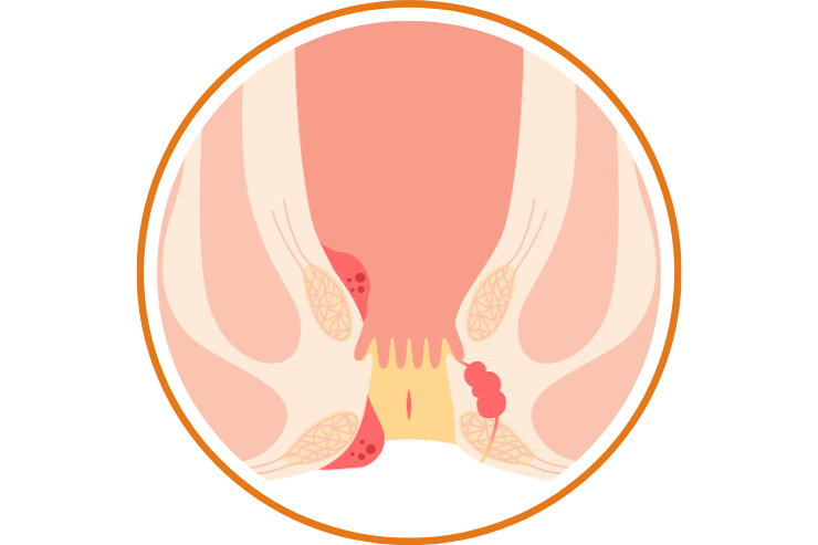 Fissure