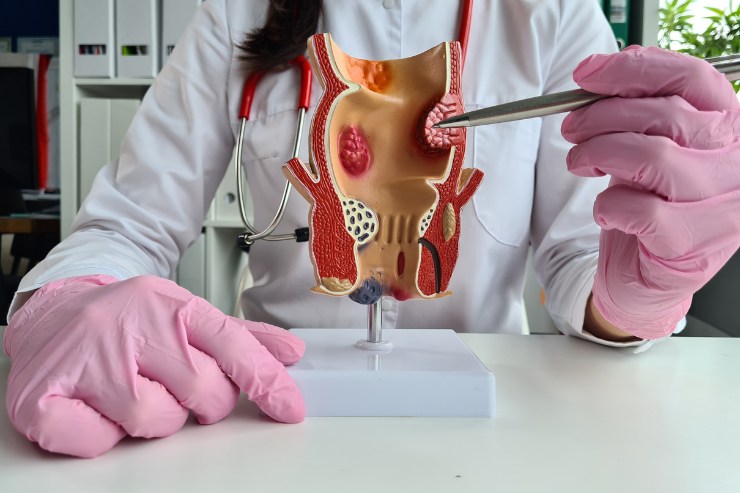 Fistula