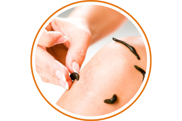 Leech Therapy-