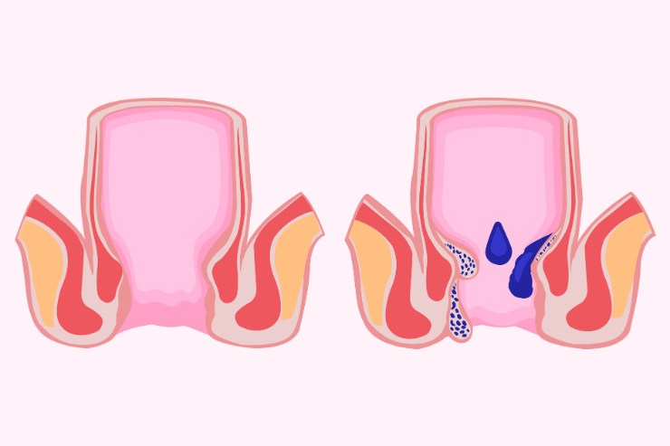 Pilonidal Sinus
