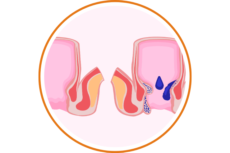 Pilonidal
